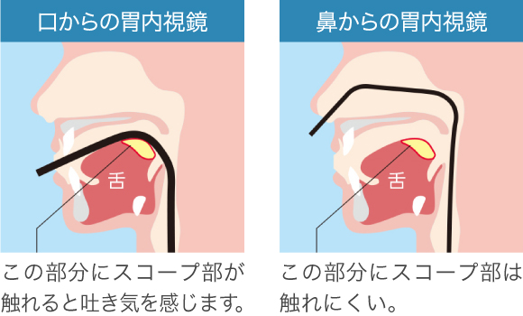 経口内視鏡・経鼻内視鏡検査